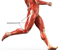 iliotibial band syndrome