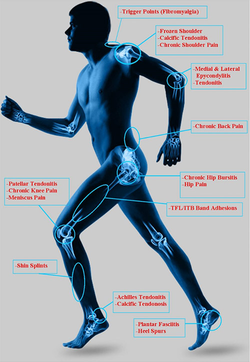 Shockwave Therapy